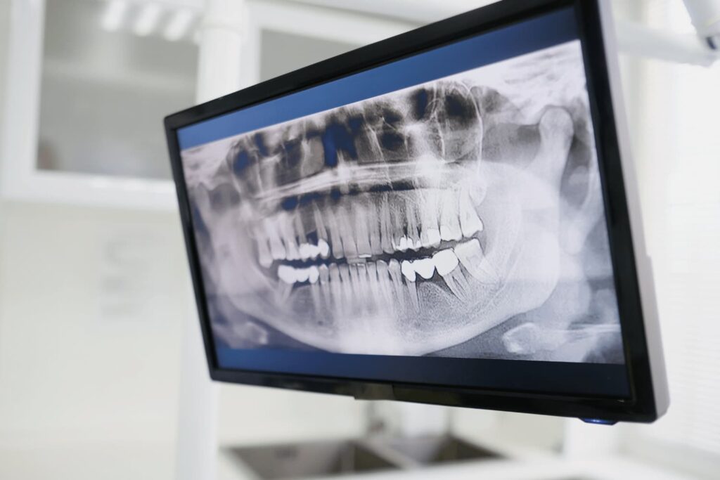 Estudiando la boca del paciente para indicar Invisalign o Brackets