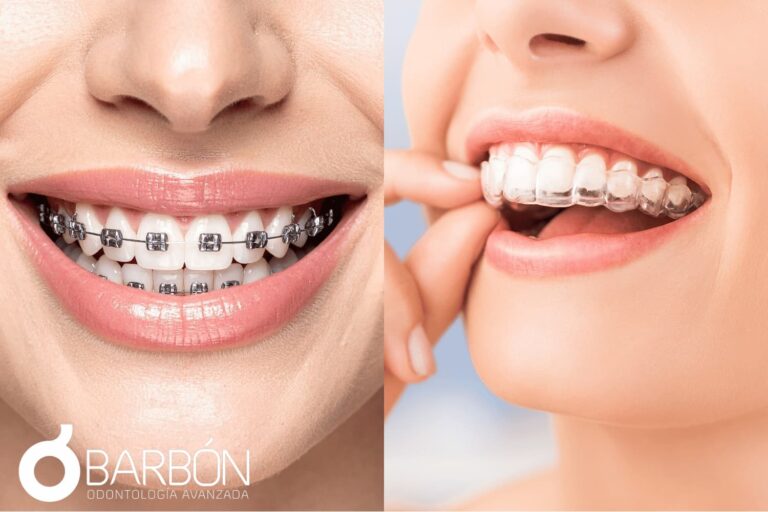 Invisalign o Brackets cuál elegir