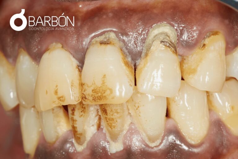 Enfermedad Periodontal