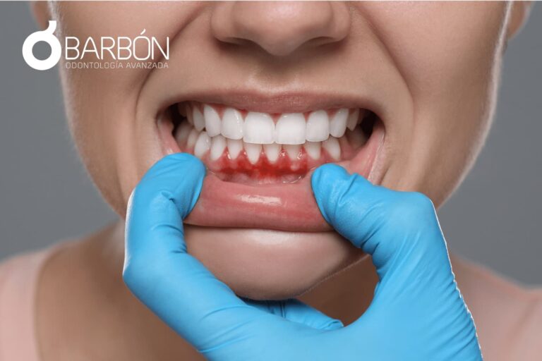 Gingivitis sintomas y tratamiento