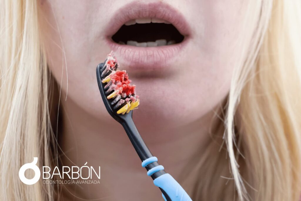 Gingivitis, síntomas y tratamiento
